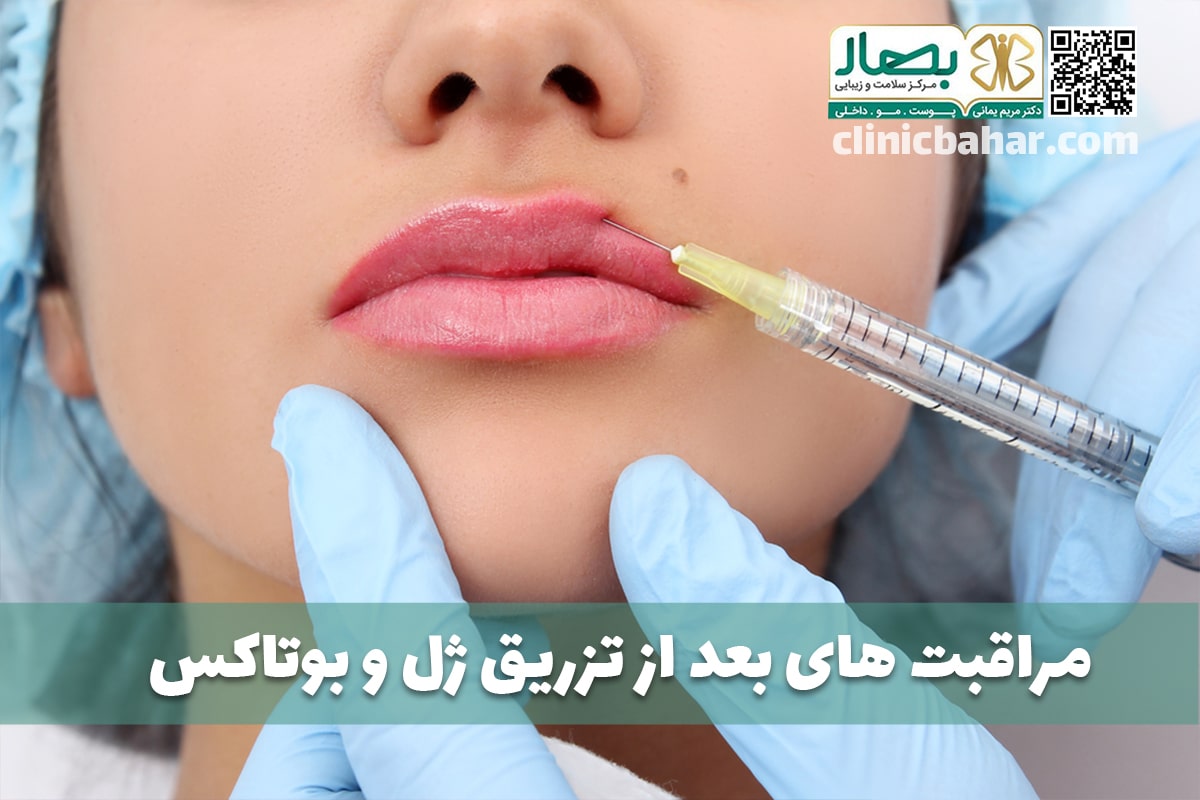 مراقبت های بعد از تزریق ژل و بوتاکس