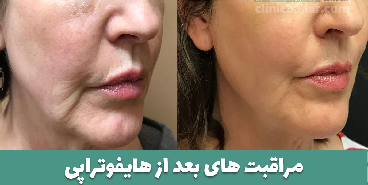 مراقبت های بعد از هایفوتراپی