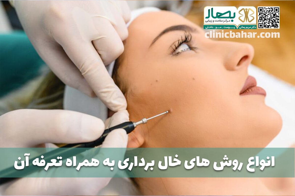انواع روش های خال برداری و تعرفه آن