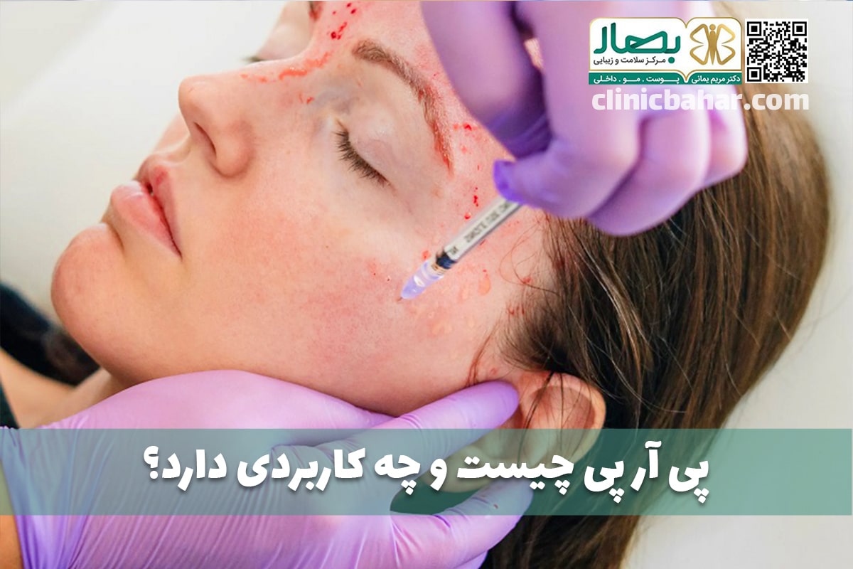 prp چیست
