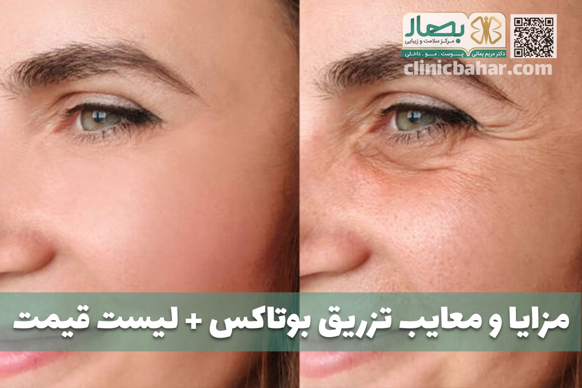 تزریق بوتاکس قیمت و هزینه