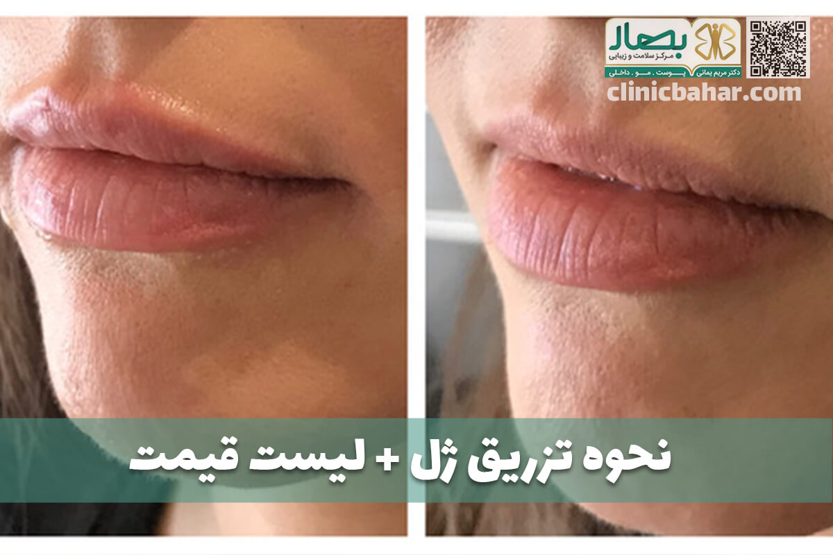 تزریق ژل