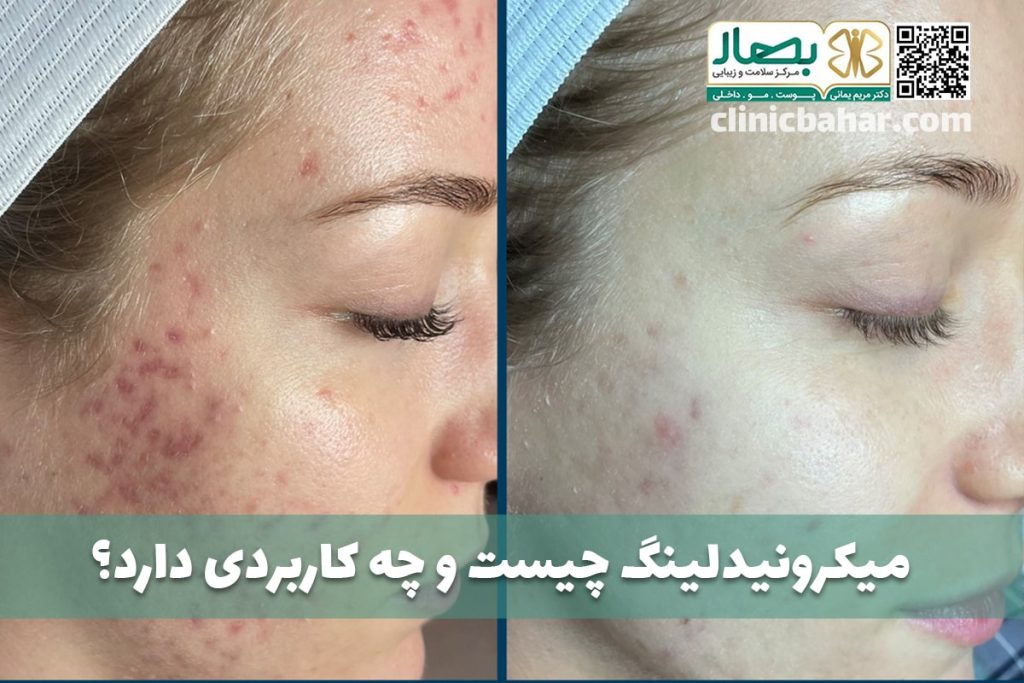 میکرونیدلینگ