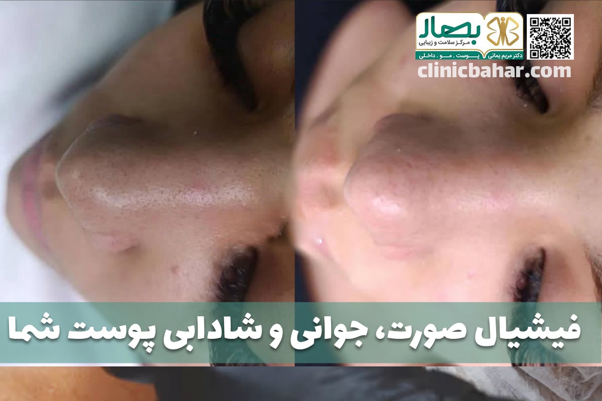 فشیال پوست صورت
