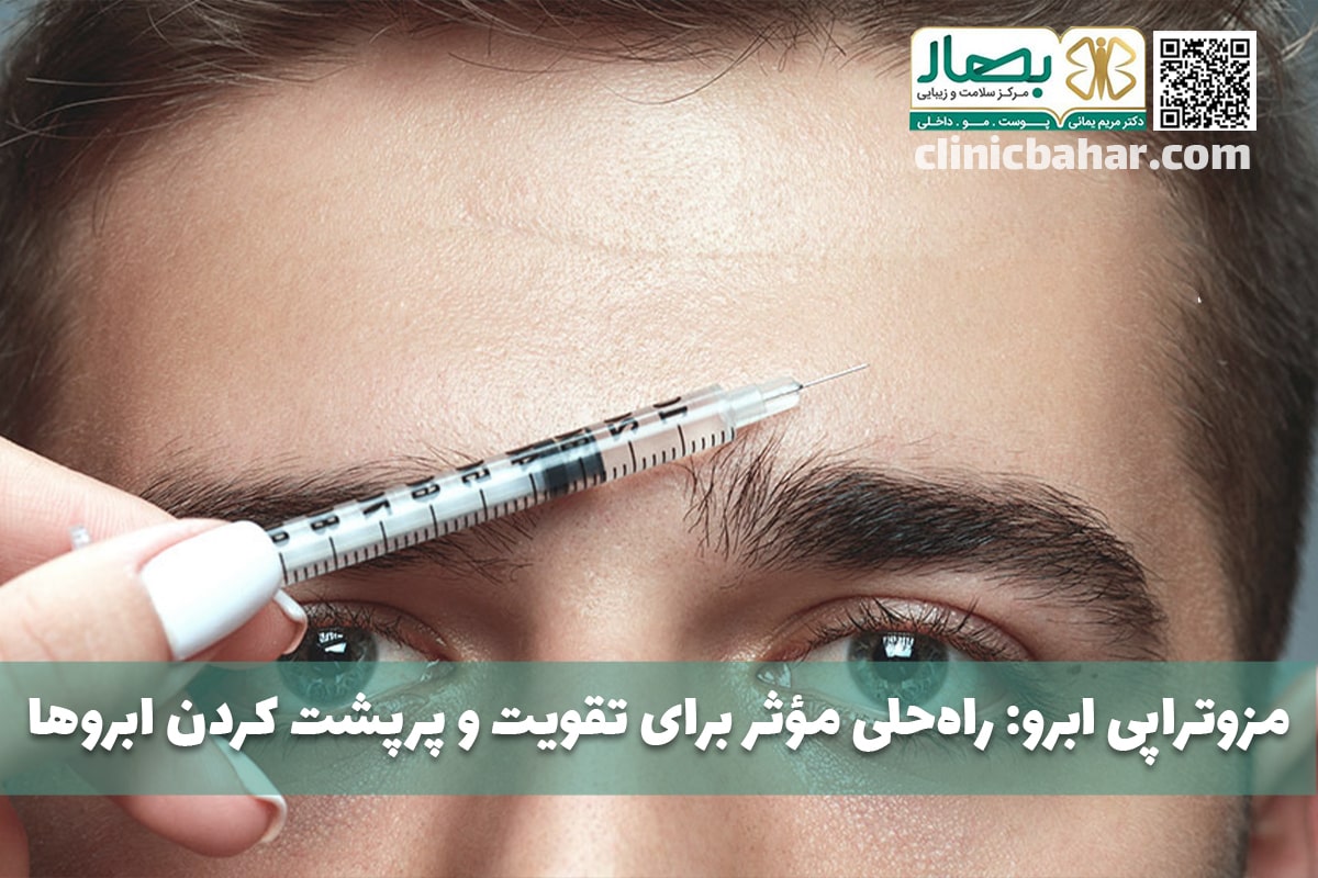 مزوتراپی ابرو
